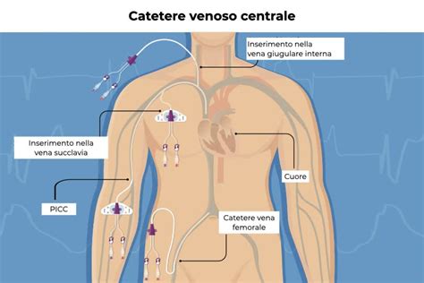 Schema che illustra le diverse misure di cateteri di aspirazione (French/Ch) e le relative applicazioni anatomiche.