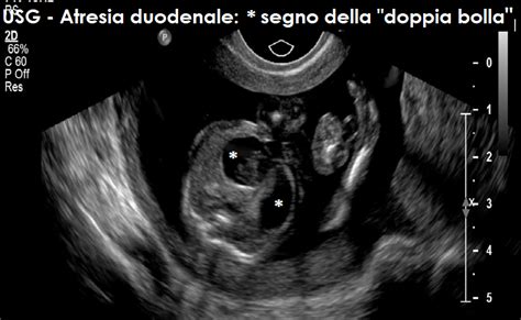 Schema di ecografia placentare con diversi gradi di maturità
