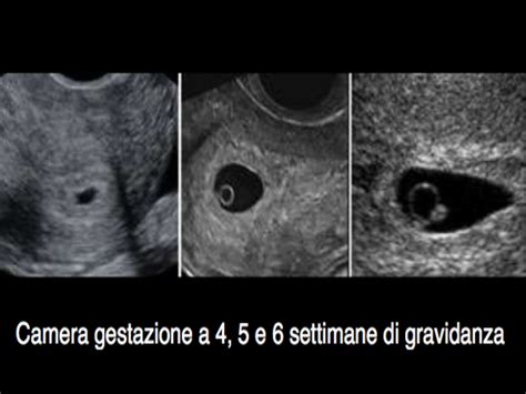 Infografica che riassume le possibili cause e implicazioni di una camera gestazionale piccola