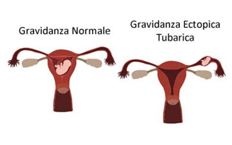 Schema diagnostico per la gravidanza ectopica