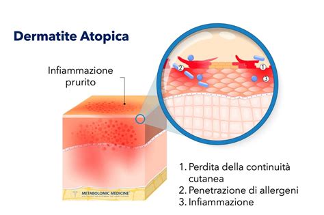 Immagine rappresentante la dermatite atopica