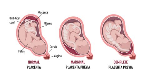 Immagine che mostra la posizione corretta della placenta nella parte superiore dell'utero e la posizione anomala della placenta previa nella parte inferiore.