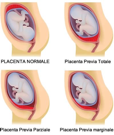 Grafico che illustra la tempistica tipica della comparsa dei sintomi della placenta previa.