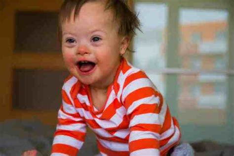 Volto di un bambino con Sindrome di Down