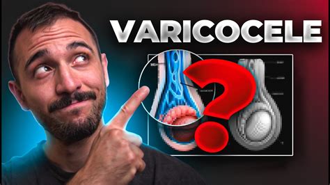 Illustrazione anatomica del varicocele