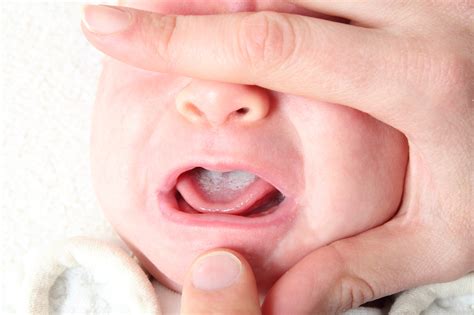 Immagine che mostra la patina bianca del mughetto sulla lingua di un neonato