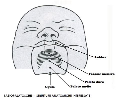 Diagramma della labiopalatoschisi