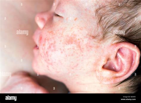 Neonato con brufoli sul viso