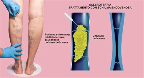 Immagine che mostra una comparazione visiva tra scleroterapia e laserterapia per i capillari