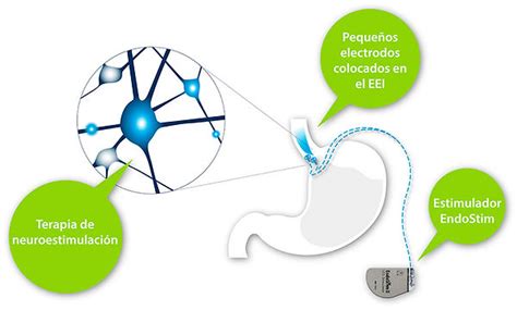Schema del sistema Endostim