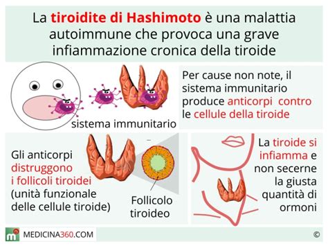 Diagramma che illustra il meccanismo autoimmune nella tiroidite di Hashimoto