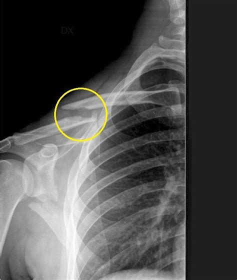 Radiografia di una frattura di clavicola neonatale