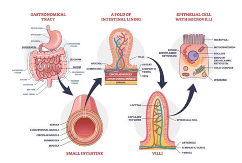 Diagramma stilizzato dell'intestino neonatale con indicazione di infiammazione