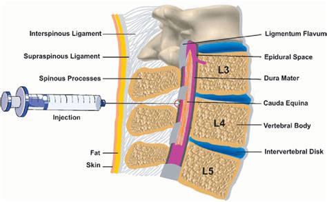 Schema anatomico dello spazio epidurale