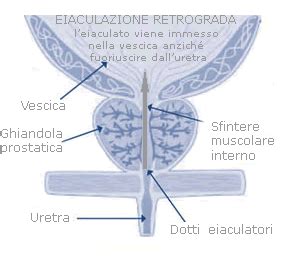 Schema di analisi delle urine post-orgasmo per la diagnosi di eiaculazione retrograda