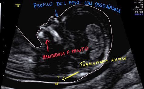 Ecografia fetale che mostra la misurazione della translucenza nucale