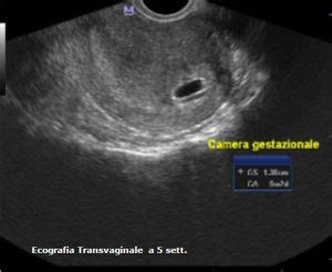 Ecografia transvaginale di un embrione
