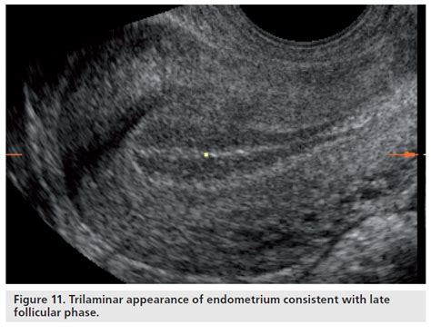 Immagine ecografica di un endometrio trilaminare