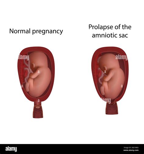 Illustrazione del sacco amniotico integro e rotto