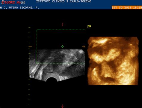 Ecografia transvaginale 2-3D che mostra l'endometrio
