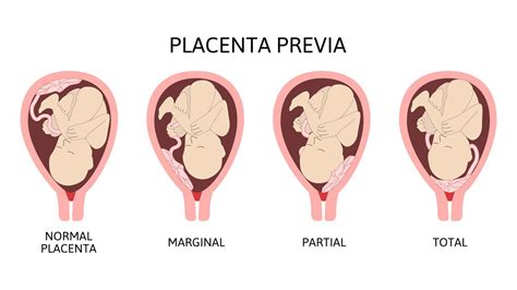 Illustrazione di una placenta previa marginale