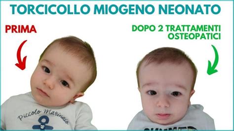 Infografica che mostra le possibili conseguenze a lungo termine del torcicollo miogeno non trattato