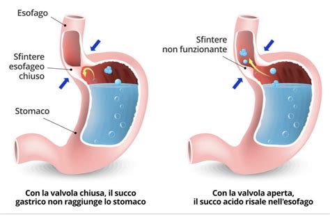 Schema anatomico dell'esofago e dello stomaco con enfasi sullo sfintere esofageo inferiore