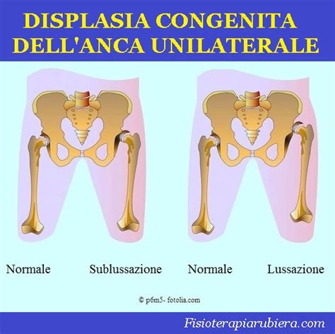 Infografica sui fattori di rischio per la displasia dell'anca nei neonati