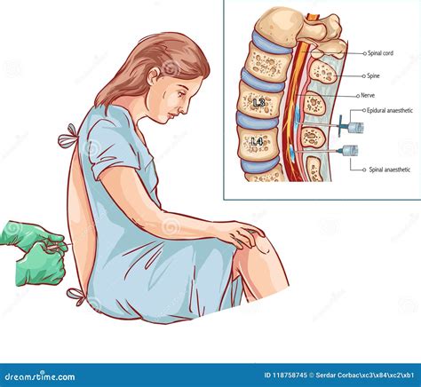 Donna in posizione per l'anestesia epidurale