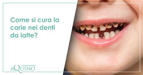 diagramma che illustra i denti colpiti da carie dovute all'uso del biberon