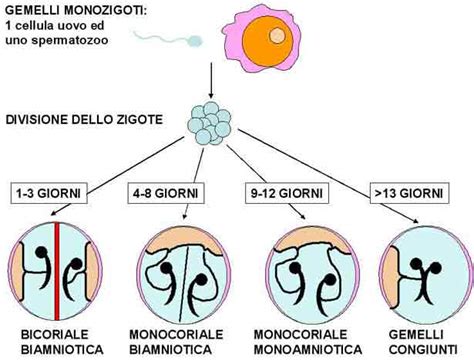 Schema di una gravidanza gemellare monocoriale con TTTS