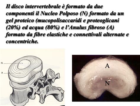 Invecchiamento del disco intervertebrale
