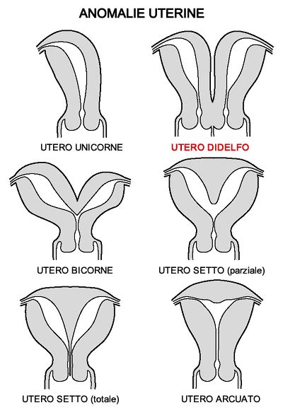 Diagramma comparativo delle diverse malformazioni uterine: utero setto, utero bicorne, utero didelfo