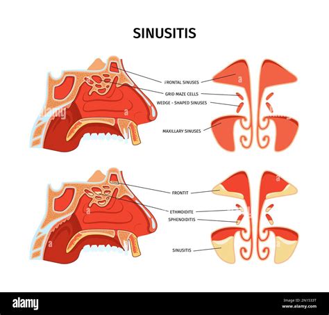 Illustrazione anatomica del naso e dei seni paranasali