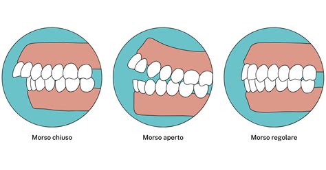 Illustrazione di morso aperto e morso crociato