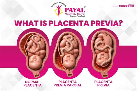 Struttura dell'utero con placenta previa