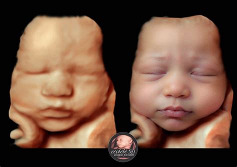 Bambino in utero con ecografia 5D