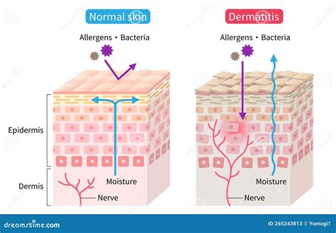 Illustrazione dei diversi stadi della dermatite associata all'incontinenza