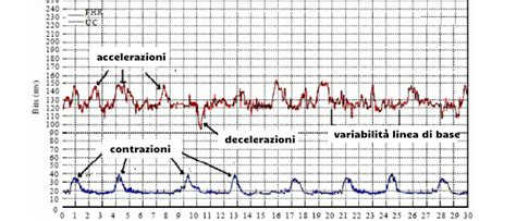 Tracciato cardiotocografico con indicazione di frequenza cardiaca basale, variabilità, accelerazioni e decelerazioni