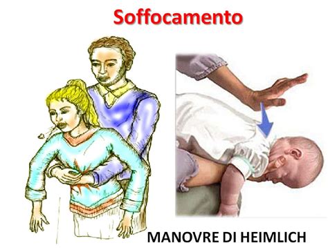 Bambino che mostra segni di soffocamento