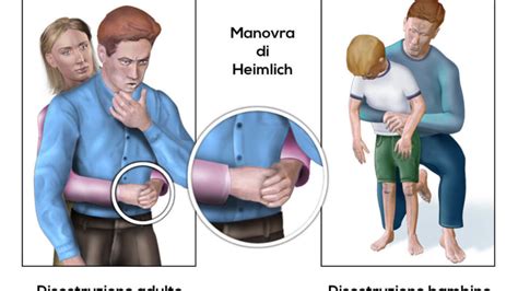 Illustrazione della Manovra di Heimlich su un adulto