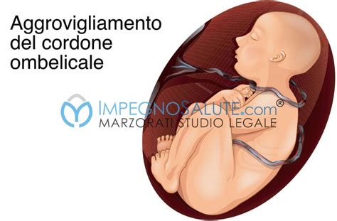 Ecografia che mostra un feto con cordone ombelicale attorno al collo