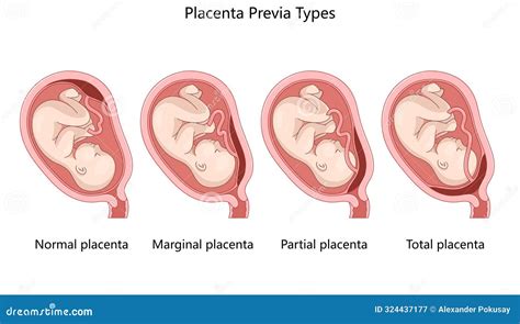 Schema che illustra le diverse tipologie di placenta previa