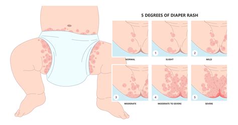 diagramma cause dermatite da pannolino