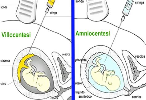 Diagramma che illustra la procedura di villocentesi
