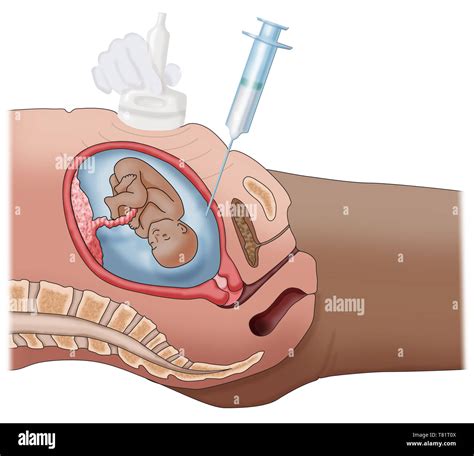 Illustrazione che mostra il processo di amniocentesi con ecografia di supporto
