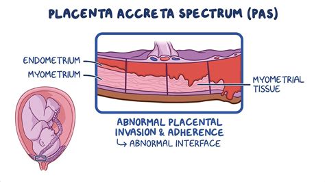 Grafico che mostra l'aumento dell'incidenza della placenta accreta in relazione al numero di cesarei pregressi