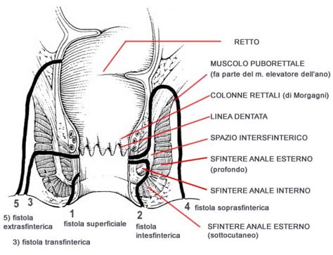 Illustrazione della tecnica LIFT per la chiusura delle fistole anali
