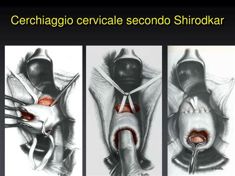 Schema illustrativo del cerchiaggio cervicale