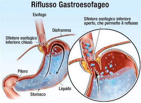 Infografica che illustra le diverse manifestazioni sintomatologiche del reflusso gastroesofageo